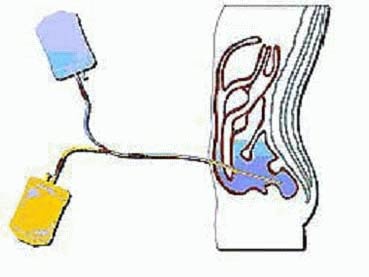 Engenharia médica - Diálise - Novotechnik